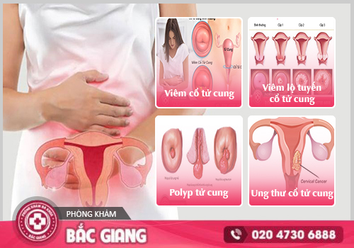 Cảnh báo sớm các bệnh tử cung thường gặp ở nữ giới